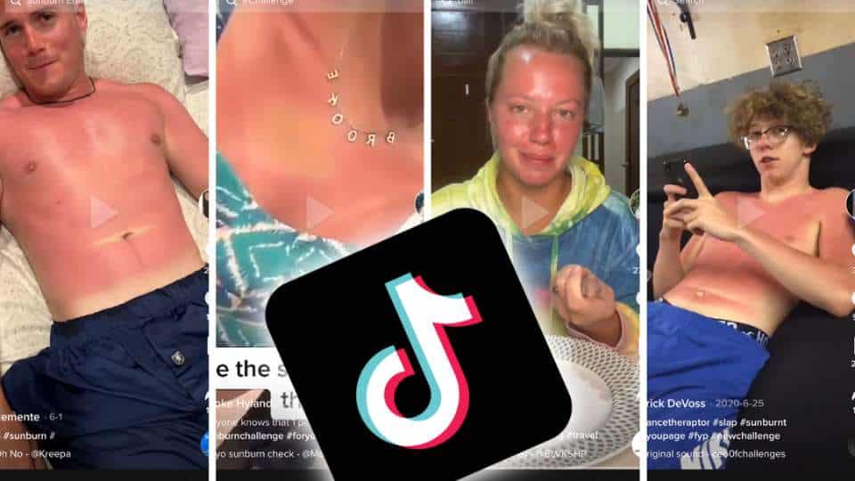 Sunburn Challenge (abbronzatura da ustione) - allarme per la nuova sfida social